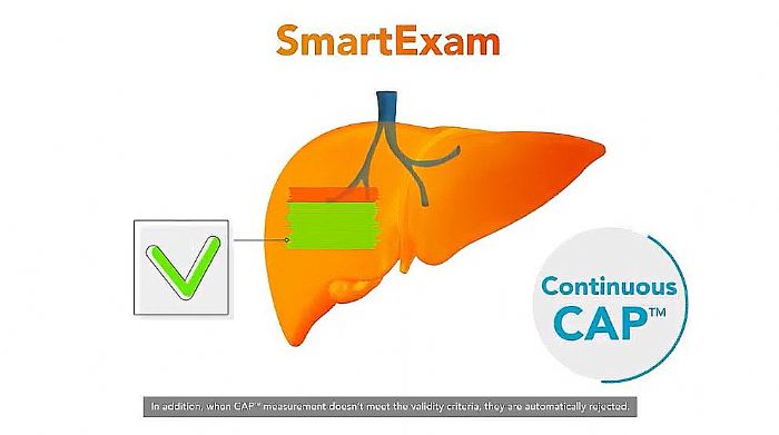 FibroScanwS˲r(sh)Ԝy(c)xӭܻ£SmartExamϵy(tng)ƽR\(yn)Sʹc(din)